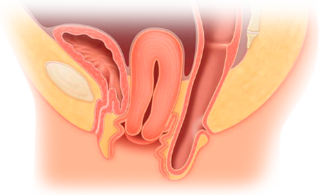 prolapsopelvico